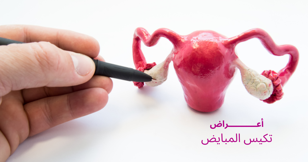 تكيس المبايض - الأعراض والأسباب